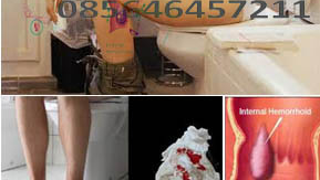 Suka Seks Anal, Waspadai Penyakit Wasir dan PMS<em></em>